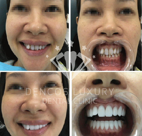 bọc răng sứ và niềng răng 4