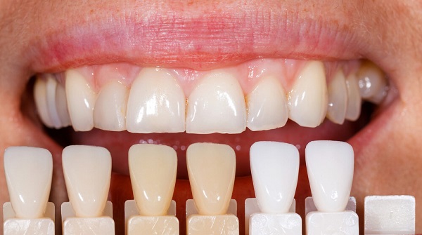 ưu điểm của bọc răng sứ