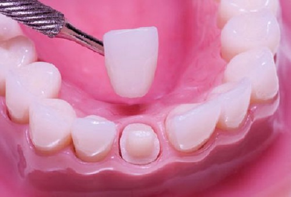 nhức răng sau khi bọc răng sứ 3