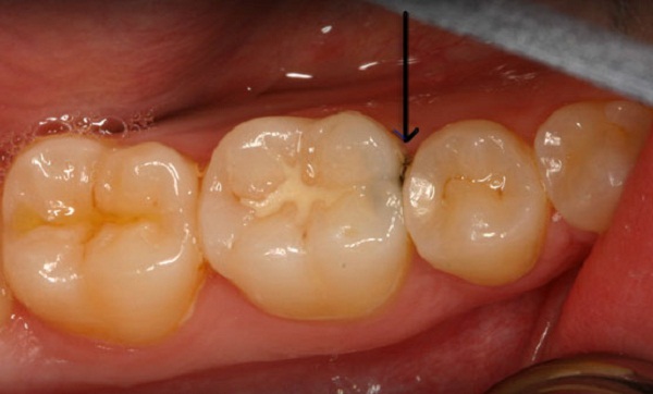 bọc răng sứ 2