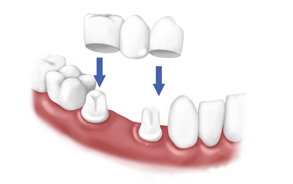 làm cầu răng sứ 4