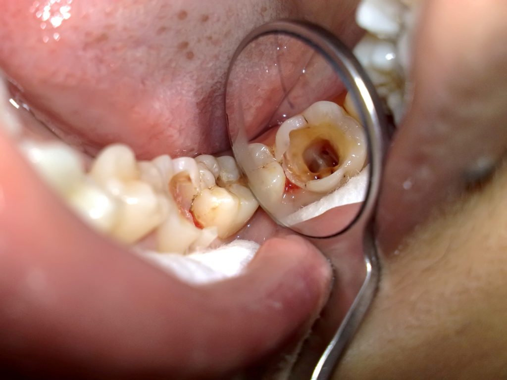  điều trị viêm tủy răng 1