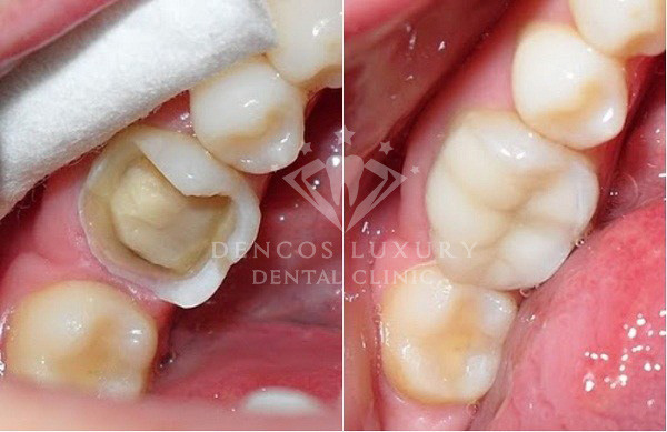 Răng sâu nên hàn trám Composite hay bọc răng sứ 4