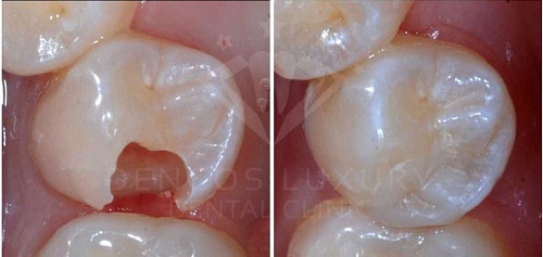 Răng sâu nên hàn trám Composite hay bọc răng sứ 3
