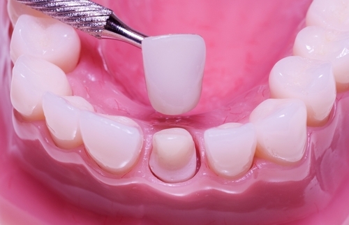 nguyên nhân của răng nhạy cảm là gì 6