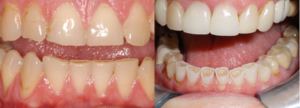 nguyên nhân của răng nhạy cảm là gì 2