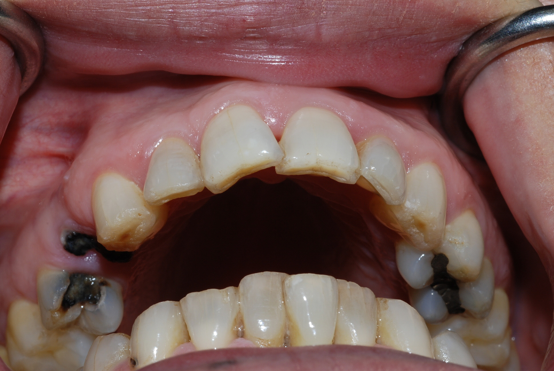 nguyên nhân của răng nhạy cảm là gì 4
