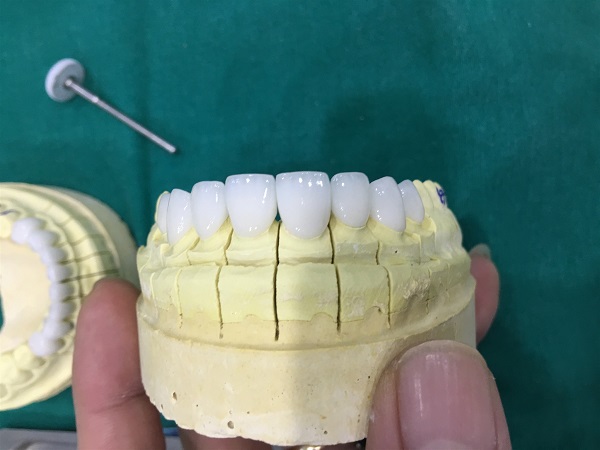độ bền của răng sứ