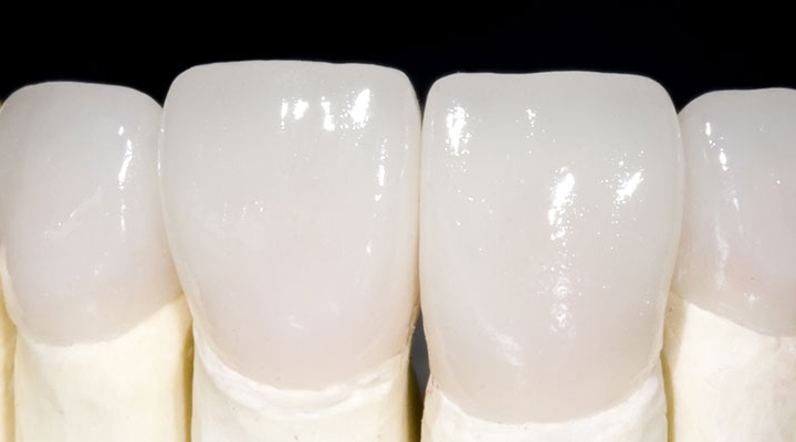 phân loại răng sứ